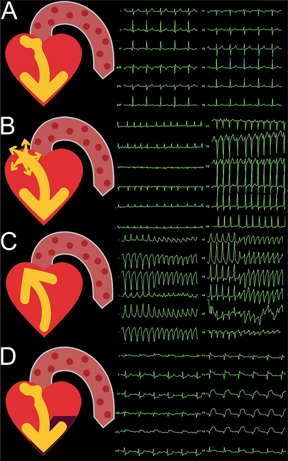 Visual Patient Heart: examples of the heart visualization beside monitoring waveforms.