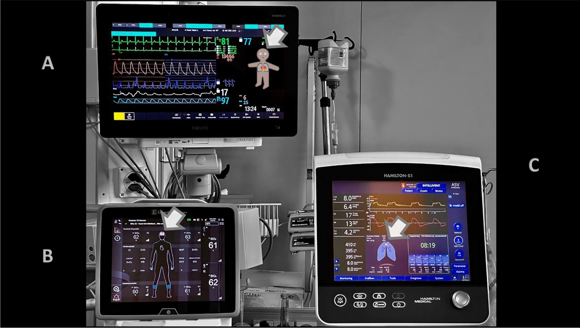 Figure 1 from Gasciauskaite et al. (2023): Philips Visual Patient Avatar, Edwards tissue oxygenation view and Hamilton Dynamic Lung panel in an intensive care unit at University Hospital Zurich.